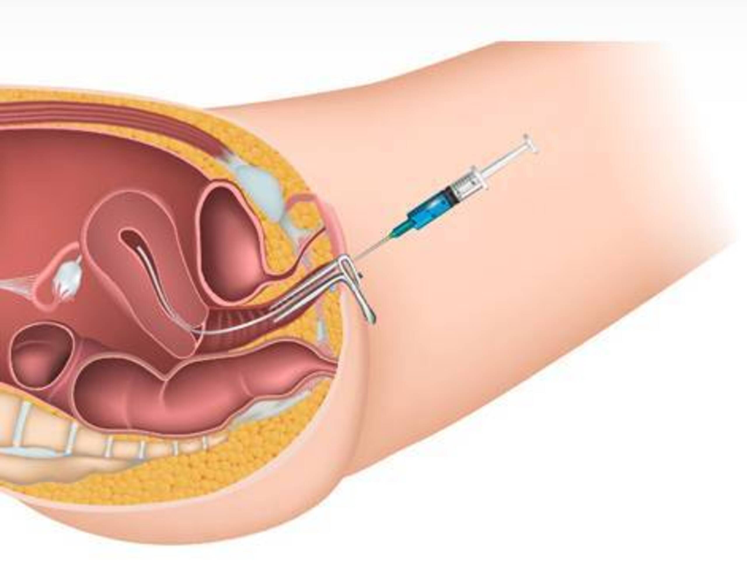 人工授精産業、分析、動向、成長概況 — 2025年〜2037年予測